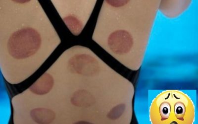 Coppettazione, segni e dolore?